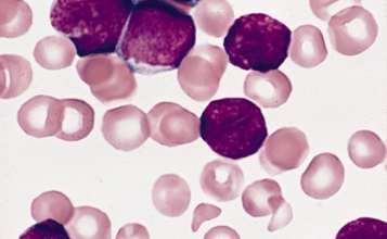 gene therapy, leukemia, acute lymphoblastic leukemia, children, US FDA, approval, cancer