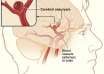 brain aneurysms, Isabel Granada, risk factors, prevention, treatment
